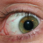 EMDR - Eye Movement Desensitization and Reprocessing
